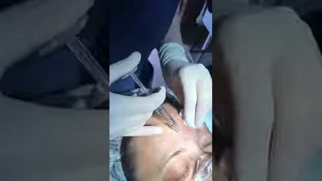 Коррекция межбровных морщин гелем стабилизированной гиалуроновой кислоты смотреть онлайн