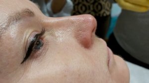 АирисКом студенты учатся: исправление кончика носа филлерами.