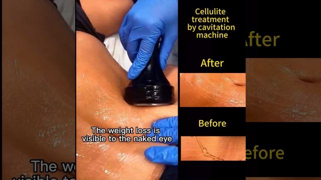 Say Goodbye to Cellulite: Effective Cellulite Treatment with Cavitation Machine