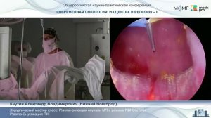 Хирургический мастер-класс- Plasma-резекция опухоли МП в режиме NBI Olympus. Plasma-энуклеация ПЖ.