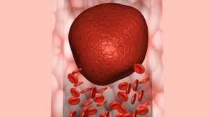 Кардиоэмболия - механизм развития кардиоэмболического варианта ишемического инсульта