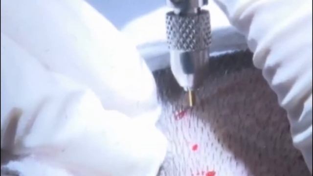 Как это сделано. Пересадка волос. смотреть онлайн