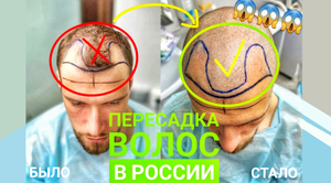 Пересадка волос в России. Блог #1