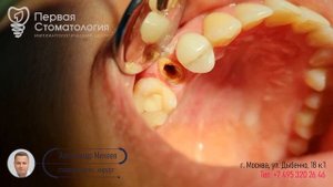 Почему нельзя ставить анкерный штифт?