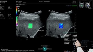 Эластография печени на Mindray Resona i9. Порядок проведения и основные ошибки