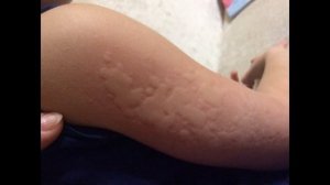 15 августа 2022 г.Эшак еми касалининг давоси.