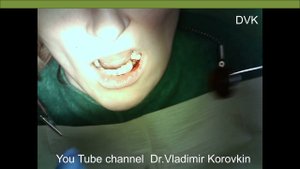 Periostotomy in the area of the 34th tooth. Installation of drainage.#abscess #pus