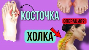 Холка - ВДОВИЙ ГОРБИК. Как избавиться? Косточка пальца ноги - халюс вальгус. Лечение без операции.