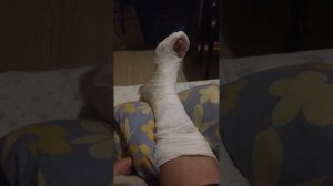 Перелом Голеностопа Правой Ноги со смещением ...