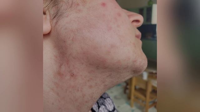 Обучение электроэпиляции на лице при запущенных случаях