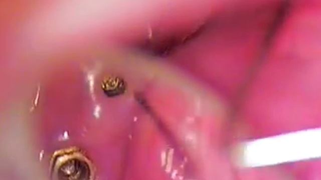 DR GERARD CUOMO - Branemark Dental Implant Broken Screw Case 1 of 7 - Boca Raton Florida смотреть онлайн