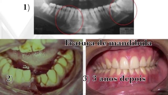 Protetor de Boca II Dentista Barra da Tijuca