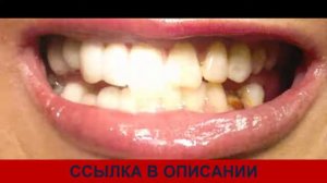 как поставить виниры snap on smile отзывы сколько стоят виниры