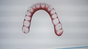 Исправление прикуса: какие брекеты выбрать