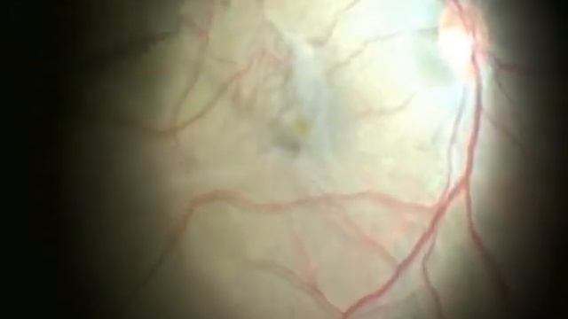 ПИЛИНГ ЭРМ БЕЗ ОКРАШИВАНИЯ (хирург д.м.н. профессор кафедры Стебнев С.Д.)) смотреть онлайн