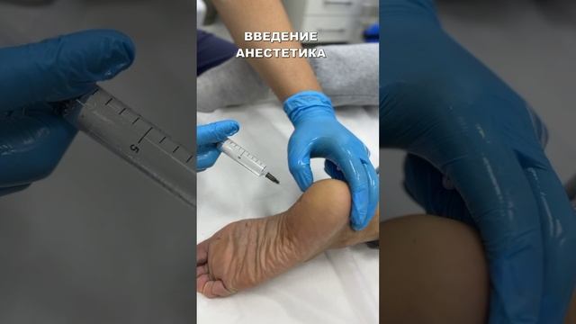 Лечебная блокада пяточной шпоры смотреть онлайн