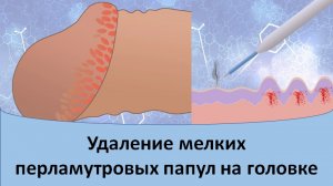 Удаление мелких перламутровых папул