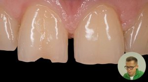 Иван Рузин, «Фронтальные композитные реставрации»