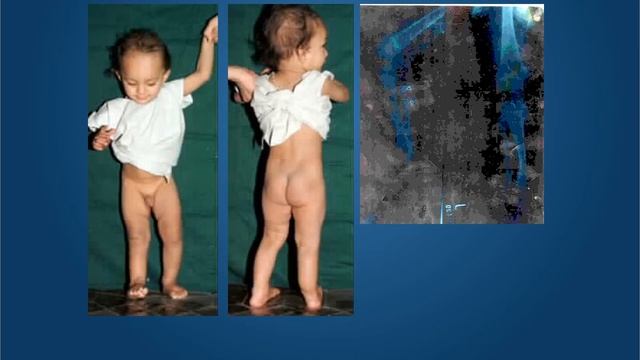 Congenital Postero Medial Bowing of tibia Early lengthening смотреть онлайн
