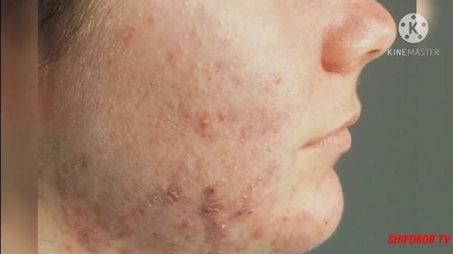 #ALLERGIYA #XAYOT #UCHUN #XAVFLIMI #DAVOSI #BORMI #АЛЛЕРГИЯ #ХАЙОТ #УЧУН #ХАВФЛИМИ #ДАВОСИ #БОРМИ