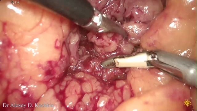 ileal ureter replacement/кишечная пластика мочеточника/стриктура/ureteral reconstruction/UPJO/ЛМС смотреть онлайн