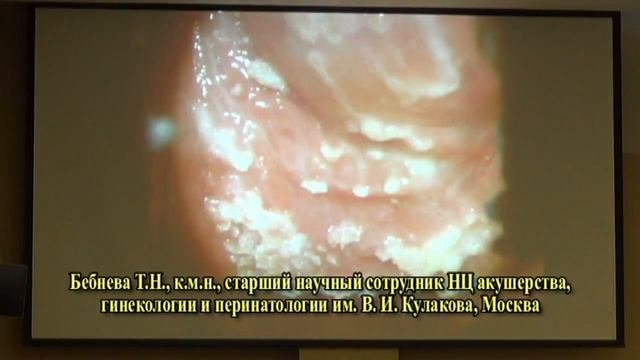 Бебнева Т.Н.Остроконечные кондиломы