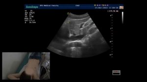 Лекция: Размеры печени  (с демонстрацией на пациенте)