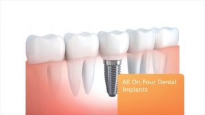 Apple Dental Group Miami FL - All On Four Dental Implants