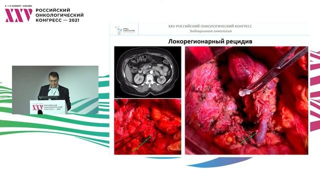 Хирургическое лечение рецидивов и метастазов адренокортикального рака