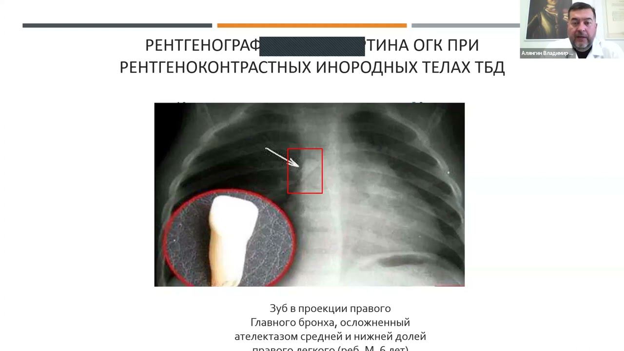 Инородные тела дыхательных путей у детей