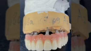 Цирконовые зубы на имплантантах. Верхняя челюсть.