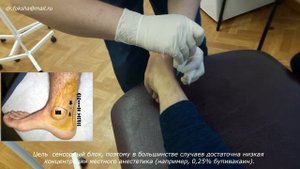 Блокада заднего большеберцового нерва по Брауну Техника блокады лодыжки Posterior Tibial Nerve Bloc