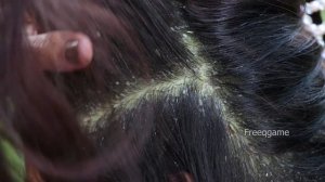 OMG!!! Scratching Psoriasis Dandruff And Satisfying Removal Lots Worm # 984