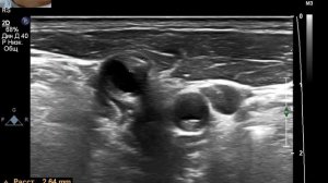 УЗИ БЦА . Как ставить датчик? Что такое ECST & NASCET?