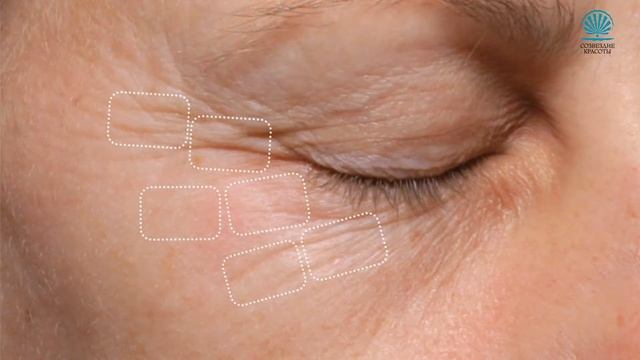 Обзор Palovia Laser Palomar - инновационного аппарата для лазерного омоложения кожи лица смотреть онлайн