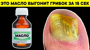 Навсегда избавилась от ГРИБКА НОГТЕЙ простым... за 15 сек. Это МАСЛО есть у всех дома!