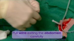 NUTRICIA: Установка гастростомы Flocare PEG