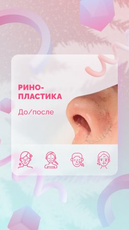 Ринопластика. До и после