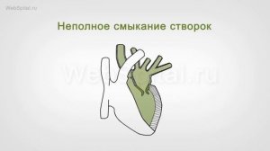 Недостаточность митрального клапана. Симптомы