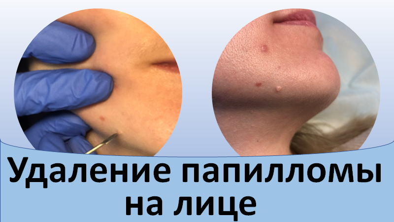 Удаление папилломы на лице