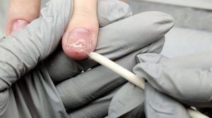 Протезирование ногтя после травмы