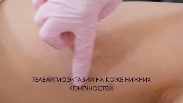У нас новый косметический LASER DEKA