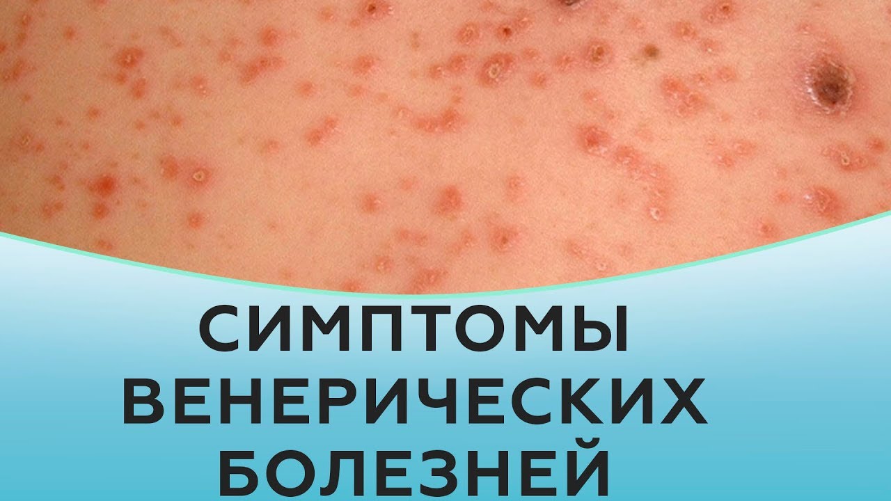 Симптомы венерических болезней.
