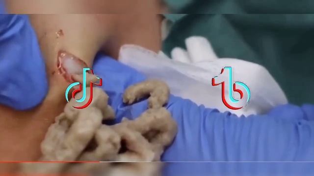 Top best Pimple popping TikTok Videos Compilation #3