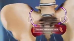 Синдром грушевидной мышцы