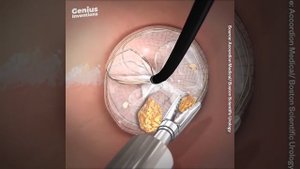 Сийдик тош касаллигининг замонавий мини инвазив даволаш усуллари