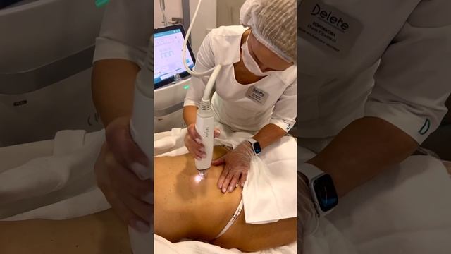 Микроигольчатый RF-лифтинг в борьбе со стриями (растяжками) и рубцами в клинике Delete! смотреть онлайн