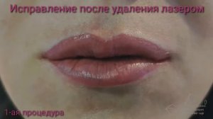 Исправление татуажа губ после удаления лазером