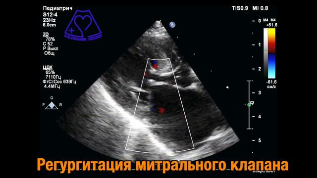 ГКМП Критическое расширение ЛП смотреть онлайн
