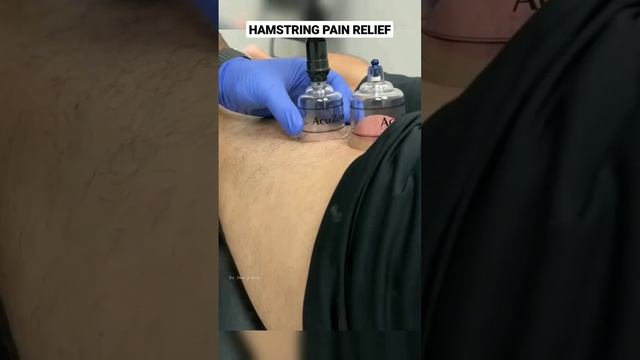 Hamstring Pain Relief#cupping #physicaltherapy #myofascialrelease #iastm #anatomy_physiology #short